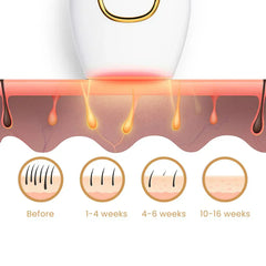إزالة الشعر بالليزر بتقنية IPL | الحل الأمثل لبشرة ناعمة في المنزل
